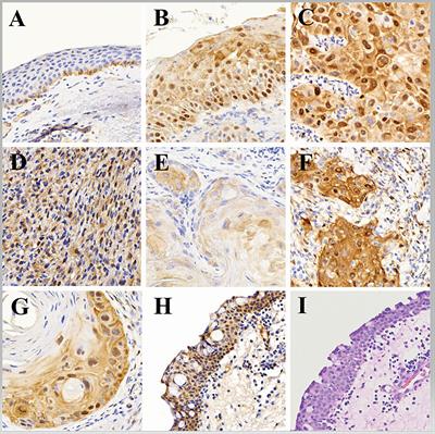 Yes-associated protein-1 overexpression in ocular surface squamous neoplasia; a potential diagnostic marker and therapeutic target